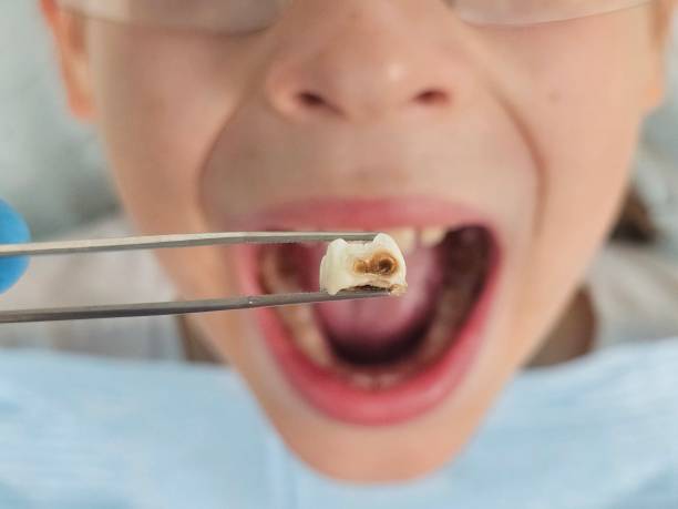Best Emergency Dental Care for Broken or Chipped Teeth in Mount Carmel, TN